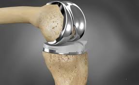 knee replacement product