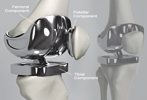 knee replacement product